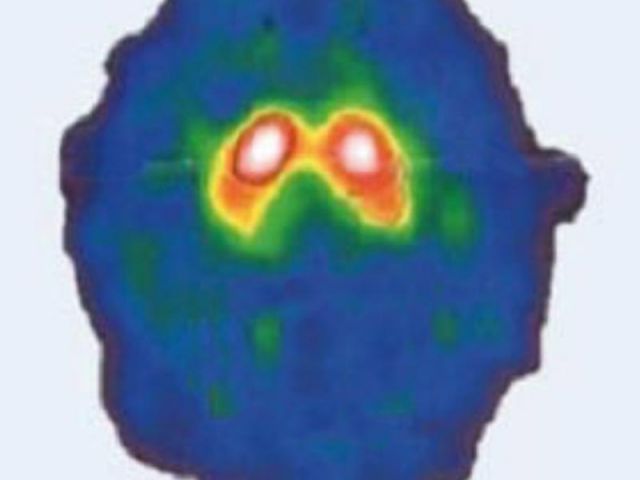 DaTSCAN-Bild von Ingrid Kaiser