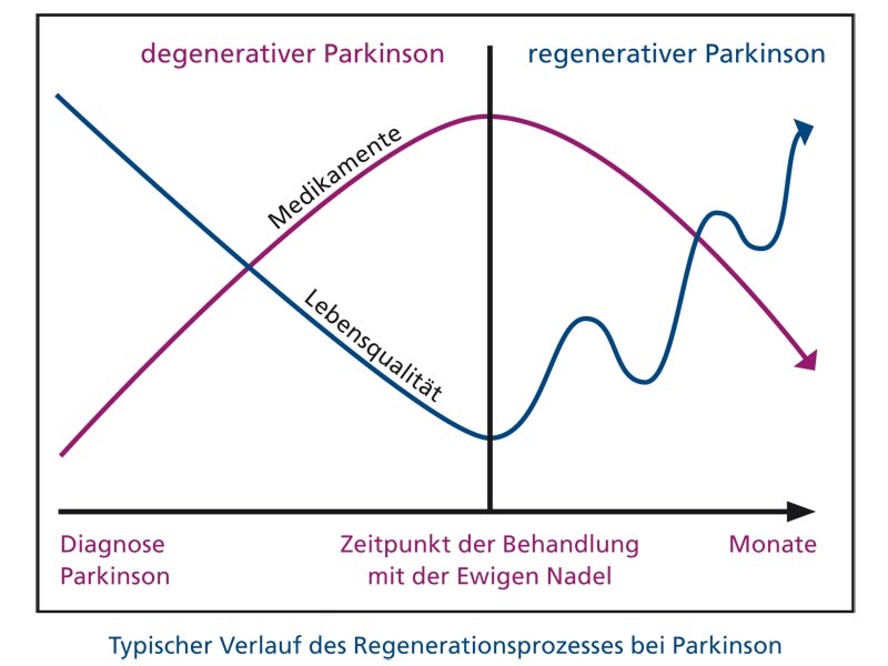 „Regenerativer Parkinson“ mit der Ewigen-Nadel-Therapie
